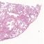 Test diagnostic - 2013 Tumeurs broncho-pulmonaires - Cas 3