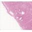 Test diagnostic - 2009 Pathologie de l'endometre - Cas 6